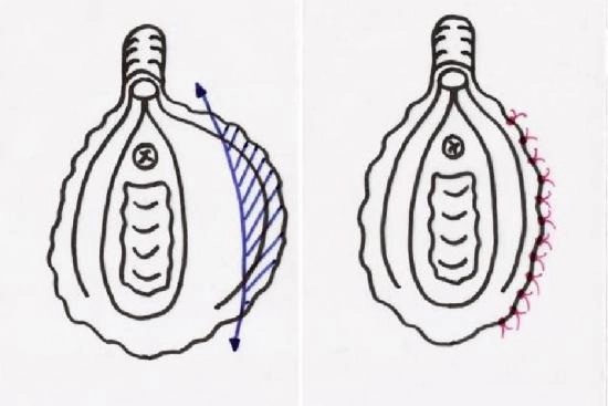 Estética genital (Vaginoplastia + labioplastia) Turquía 