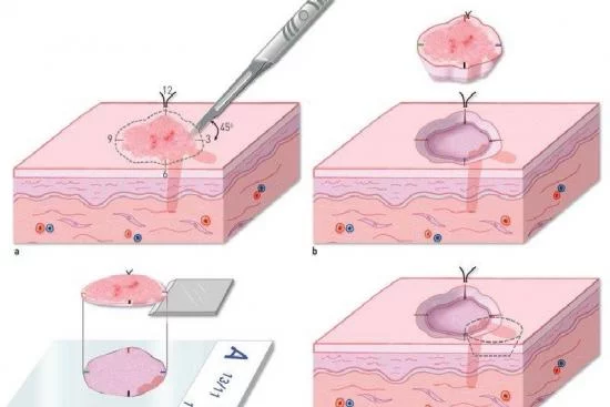 El proceso de la cirugía de extirpación del cáncer de piel 2024
