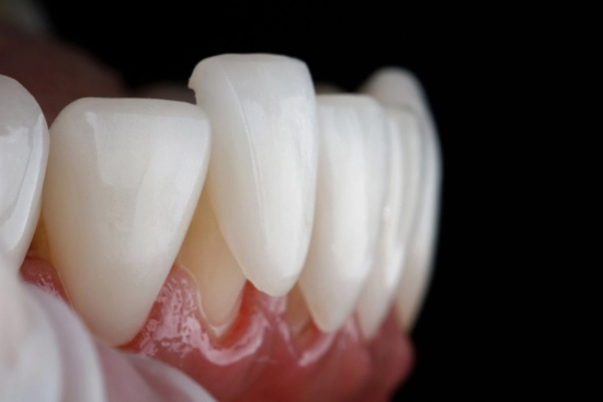 Dental veneers: When are they not recommended? 2026
