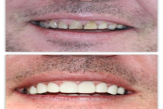  Photos: Before / After 0 in Turkey dental veneers, turkey, price, reviews, istanbul, dentist, clinic