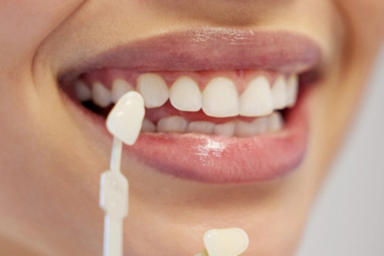 Types of dental veneers in Turkey 2026