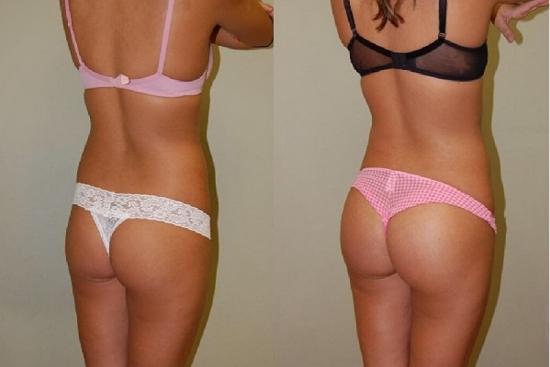  Photos: Before / After 0 in Turkey brazilian butt lift,lift,reviews,best brazilian butt lift doctors,best,doctors,bbl plastic surgery,treatment,cost,bum lift,bum,doctor,hospital,clinic,turkey,istanbul