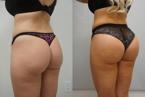 What Happens During a Brazilian Butt Lift, or BBL?