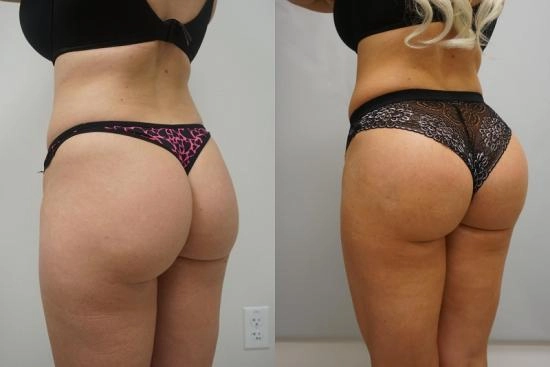 Photos Avant / Après 4 BBL en Turquie, lifting brésilien des fesses, prix, avis, chirurgie bbl, lipofilling, Turquie