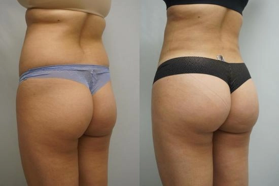 Photos Avant / Après 3 BBL en Turquie, lifting brésilien des fesses, prix, avis, chirurgie bbl, lipofilling, Turquie
