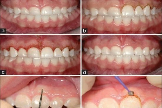 Photos Avant / Après 3 gingivectomie, Turquie, prix