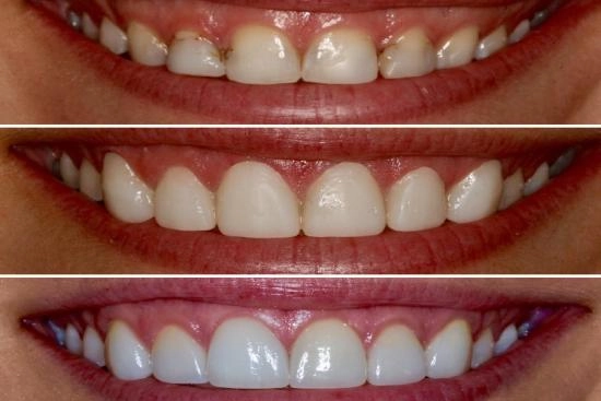 Photos Avant / Après 1 gingivectomie, Turquie, prix