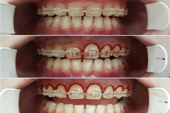 Photos Avant / Après 4 gingivectomie, Turquie, prix