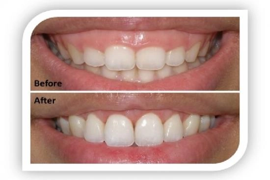Photos Avant / Après 5 gingivectomie, Turquie, prix