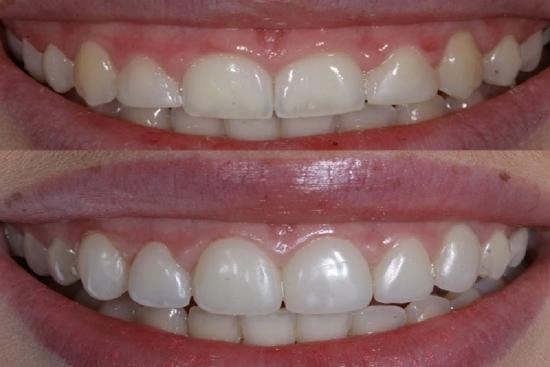 de nuestros pacientes 0 gingivectomía, Turquía, precio