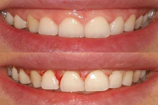 Photos Avant / Après 2 gingivectomie, Turquie, prix