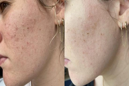 Photos Avant / Après 1 peeling chimique du visage, peeling à l'acide, effets secondaires, Turquie, prix