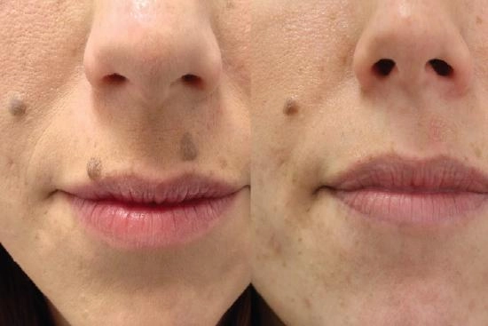 of our patients 1 mole removal, laser, scalpel, Turkey, costs