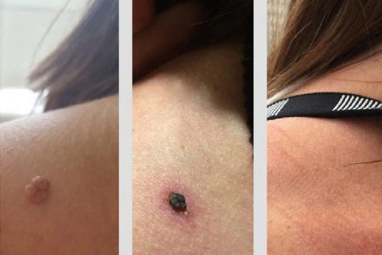 of our patients 3 mole removal, laser, scalpel, Turkey, costs