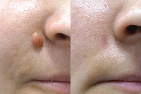 of our patients 2 mole removal, laser, scalpel, Turkey, costs