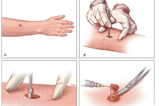 Mole Removal on Face: Recovery period 2024