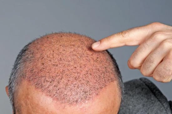 Pre-operative consultation: the key step before hair transplant 2025