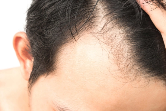 Post-hair transplant recovery and care 2025