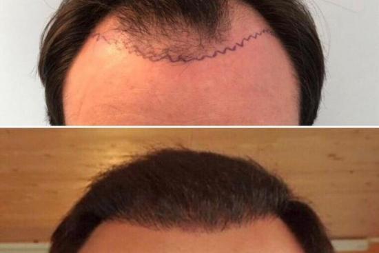  Photos: Before / After 0 in Turkey hair transplant, FUE, DHI, turkey, cost, best