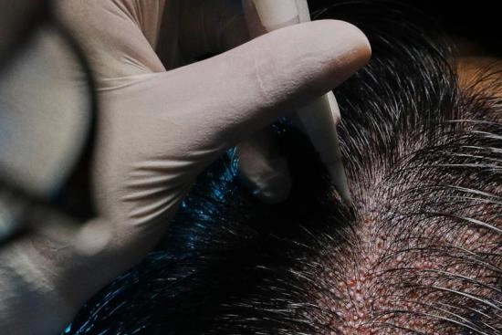 Can I avoid shaving during a hair transplant procedure? 2025