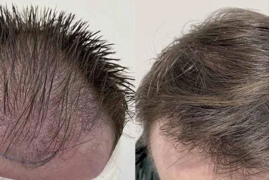of our patients 0 Synthetic hair transplant, Turkey, cost