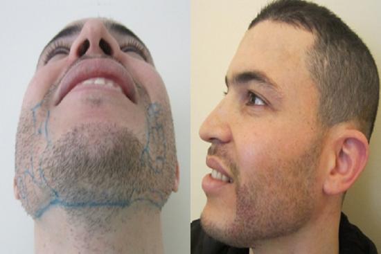  Photos: Before / After 0 in Turkey risks, beard implants, fue, turkey, beard transplant, cost, Antalya