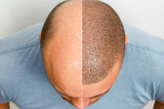 Greffe de cheveux sans rasage Turquie