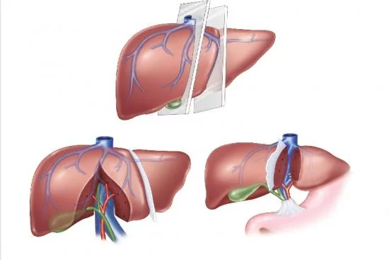 Liver transplant Turkey 