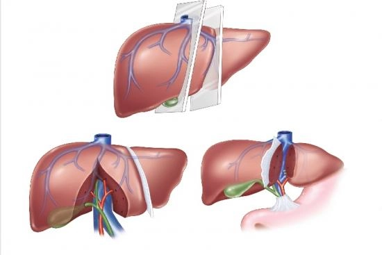 Можно ли пересадить печень