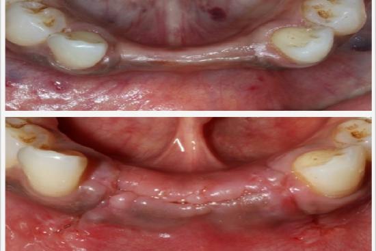  Photos: Before / After 0 in Turkey dental bone graft,dental,cost,Bone Grafting for Dental Implants,Grafting,Implants,doctor,turkey,istanbul,price,clinic,hospital