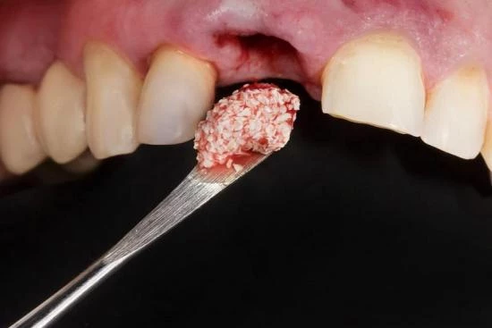 صور عملية زراعة عظم في الاسنان