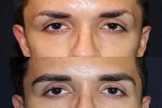 Eyebrow transplant in Istanbul Turkey| Clinics & Cost