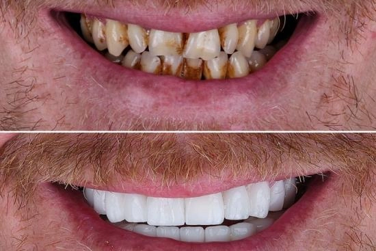 de nuestros pacientes 6 hollywood smile, precio, revisión, hollywood smile, clínica, dental, Turquía, Estambul, doctor, 