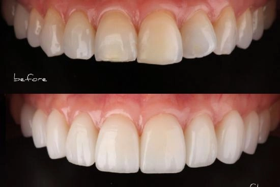 de nuestros pacientes 1 hollywood smile, precio, revisión, hollywood smile, clínica, dental, Turquía, Estambul, doctor, 