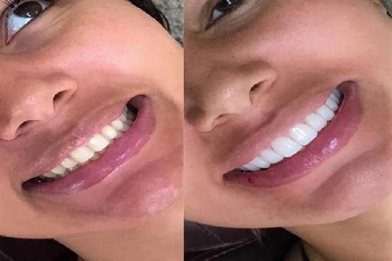 de nuestros pacientes 4 hollywood smile, precio, revisión, hollywood smile, clínica, dental, Turquía, Estambul, doctor, 