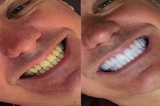 de nuestros pacientes 3 hollywood smile, precio, revisión, hollywood smile, clínica, dental, Turquía, Estambul, doctor, 