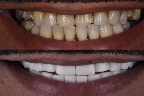 de nuestros pacientes 5 hollywood smile, precio, revisión, hollywood smile, clínica, dental, Turquía, Estambul, doctor, 