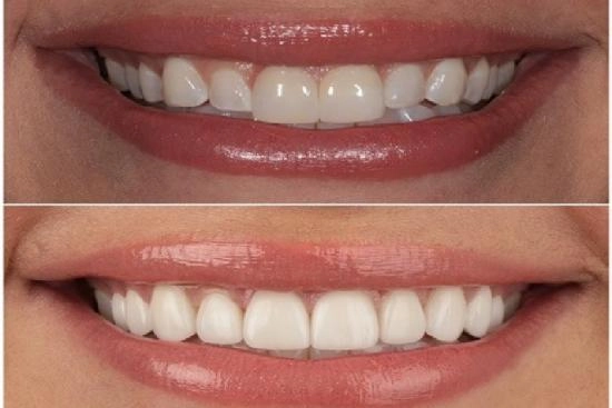 de nuestros pacientes 2 hollywood smile, precio, revisión, hollywood smile, clínica, dental, Turquía, Estambul, doctor, 
