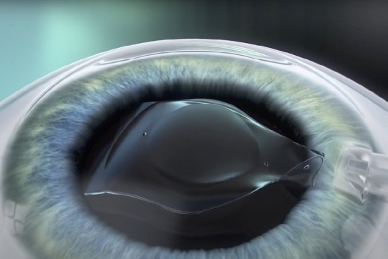 Implants phakes ICL Turquie 