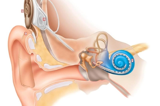 Tipos de implantes cocleares