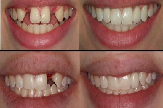 الصور قبل / بعد 0 في تركيا زراعة الأسنان, تركيا, اسعار, أفضل ,عيادة, اسنان
