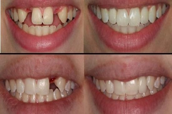 لمرضانا 0 زراعة الأسنان, تركيا, اسعار, أفضل ,عيادة, اسنان