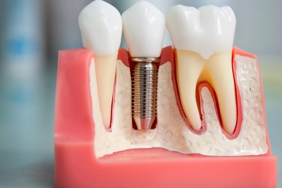 Mantenimiento de un implante dental 2025