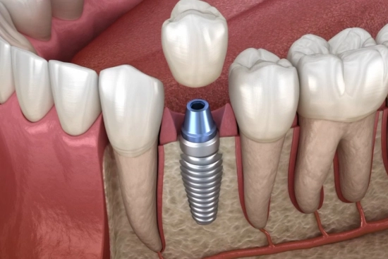 Stages of dental implantation in Turkey 2026