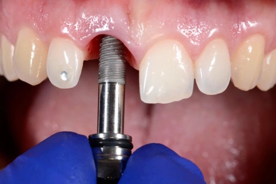 How many dental implants will I need ? 2024