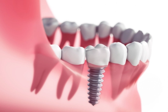 ¿Cuáles son las contraindicaciones del reemplazo de dientes? 2024