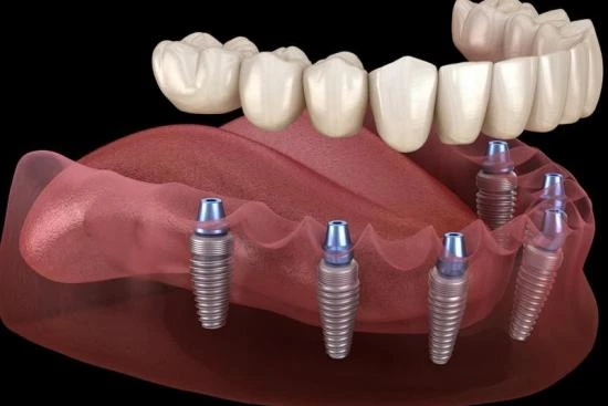 Немедленная установка зубных имплантатов Турция 