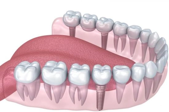 Zygomatic implants in Turkey