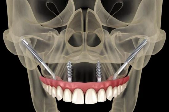 What is a zygomatic implant? 2024