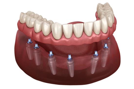 Имплантация зубов All-on-6 